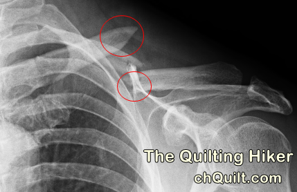 clavicle-break